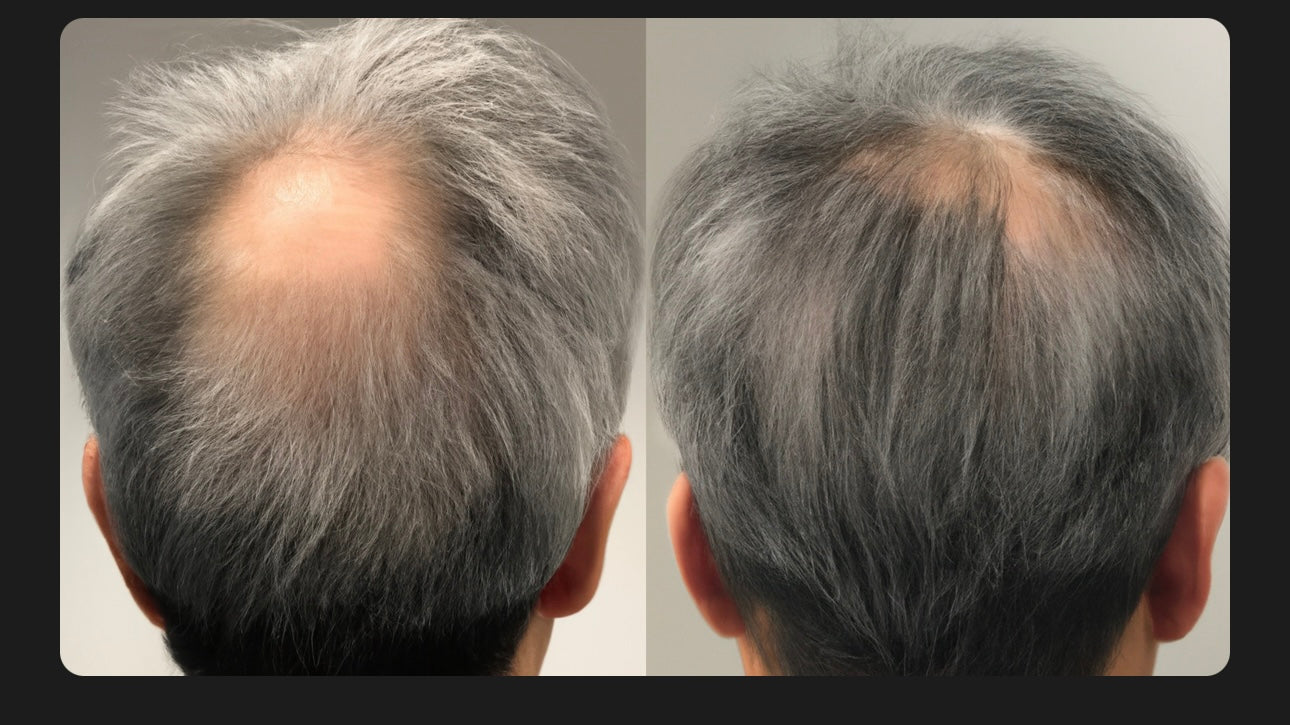 SHAMPOO ANTICAIDA DE CABELLO | BIOTINA + MINOXIDIL 15% + BERGAMOTA + COLA DE CABALLO | 250ML