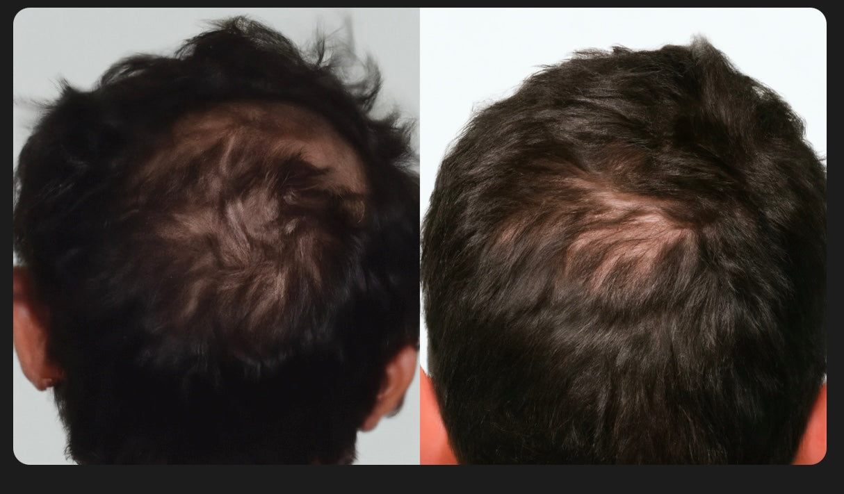 SHAMPOO ANTICAIDA DE CABELLO | BIOTINA + MINOXIDIL 15% + BERGAMOTA + COLA DE CABALLO | 250ML