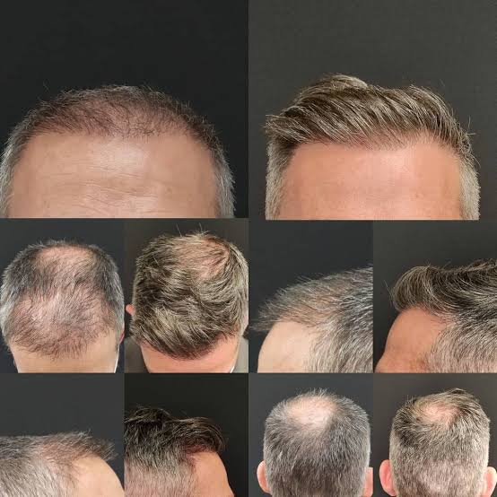 SHAMPOO ANTICAIDA DE CABELLO | BIOTINA + MINOXIDIL 15% + BERGAMOTA + COLA DE CABALLO | 250ML