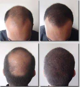 SHAMPOO ANTICAIDA DE CABELLO Y BARBA | BIOTINA + MINOXIDIL 15% +BERGAMOTA + COLA DE CABALLO | 250ML
