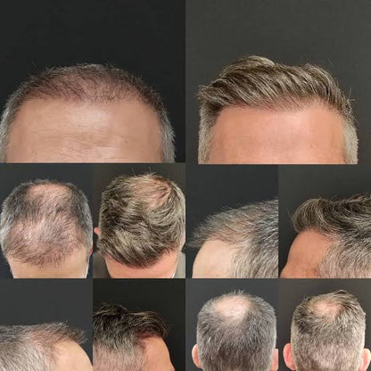 SHAMPOO ANTICAIDA DE CABELLO Y BARBA | BIOTINA + MINOXIDIL 15% +BERGAMOTA + COLA DE CABALLO | 250ML