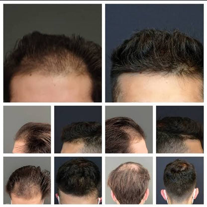 SHAMPOO ANTICAIDA DE CABELLO Y BARBA | BIOTINA + MINOXIDIL 15% +BERGAMOTA + COLA DE CABALLO | 250ML